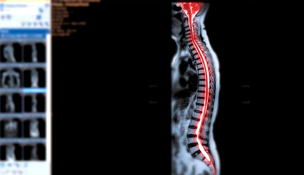 Avances en el tratamiento de la lesión de médula espinal
