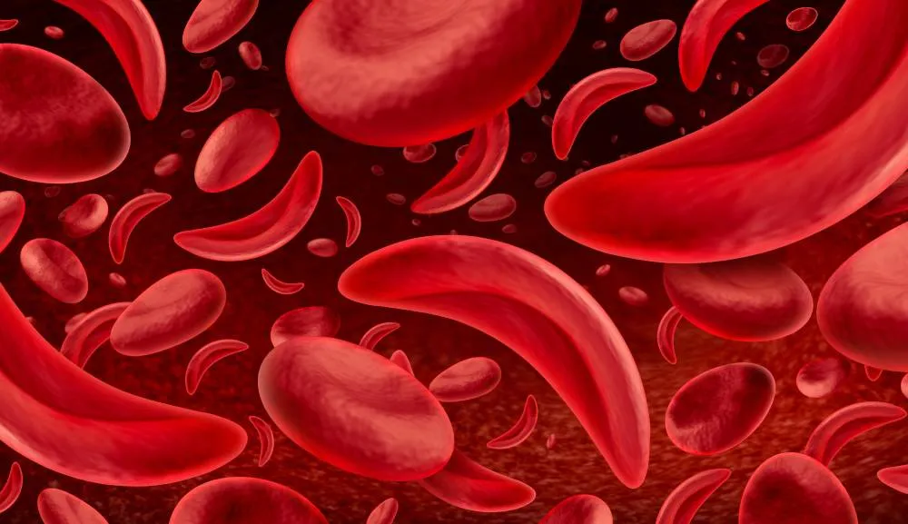 Anemia falciforme, ¿qué es y por qué se conmemora en esta fecha?