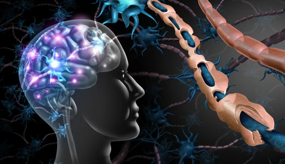 Enfoques terapéuticos y reflexiones bioéticas sobre esclerosis múltiple en Food for the Brain