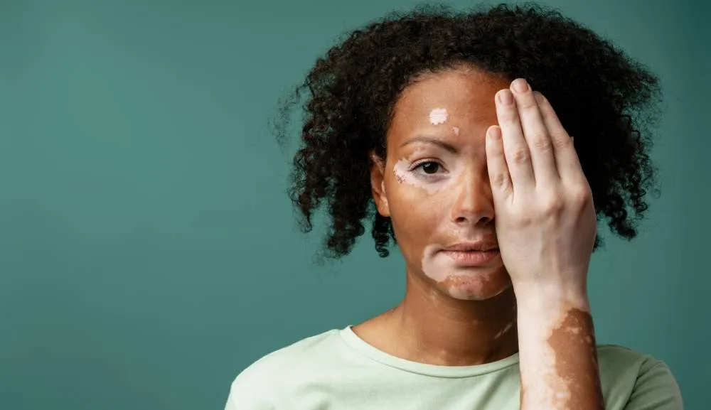 Día Mundial del Vitiligo, una enfermedad con muchas más implicaciones